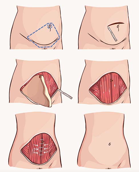 Tummy Tuck - Medlife Group