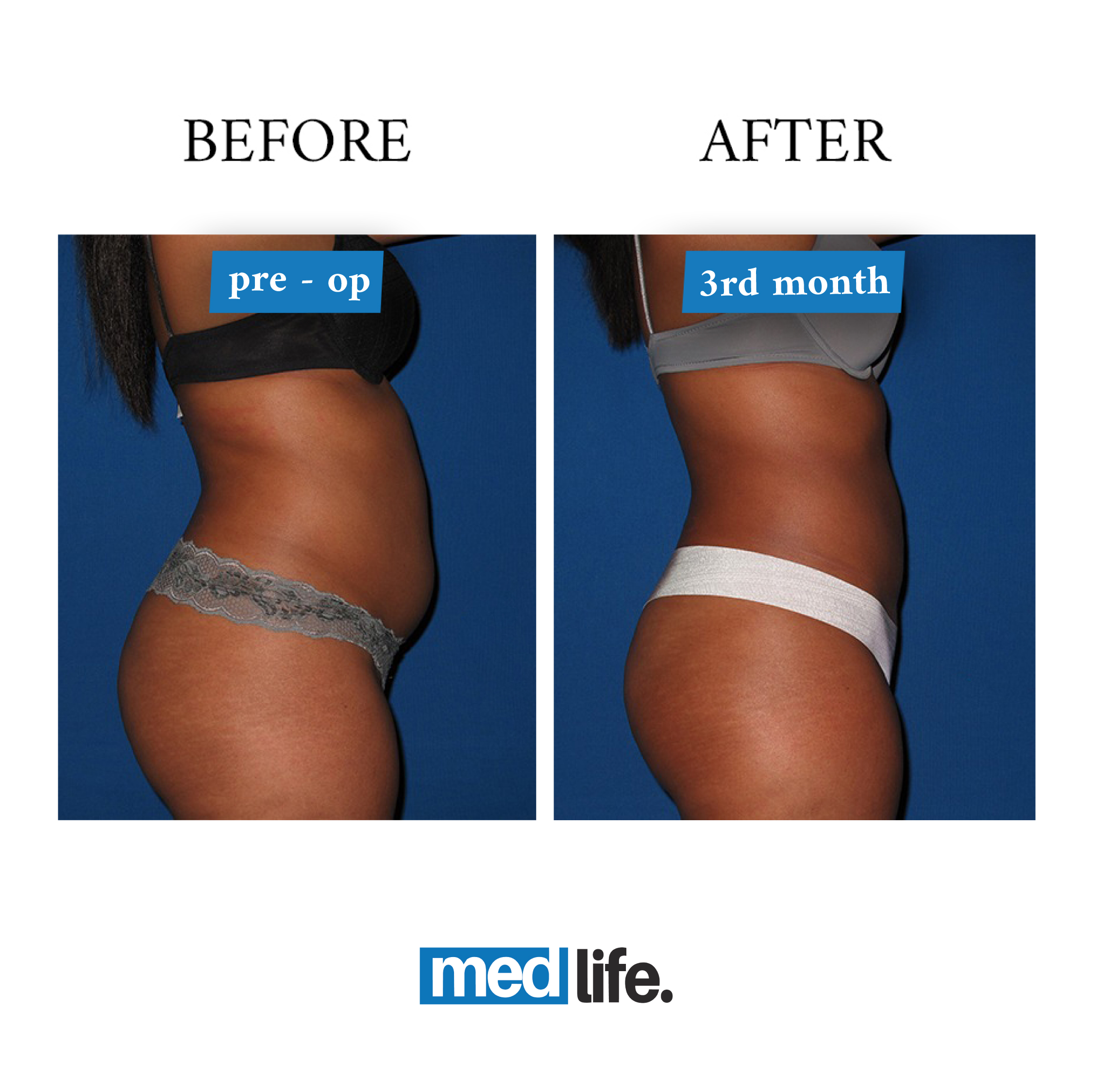 Tummy Tuck - Medlife Group